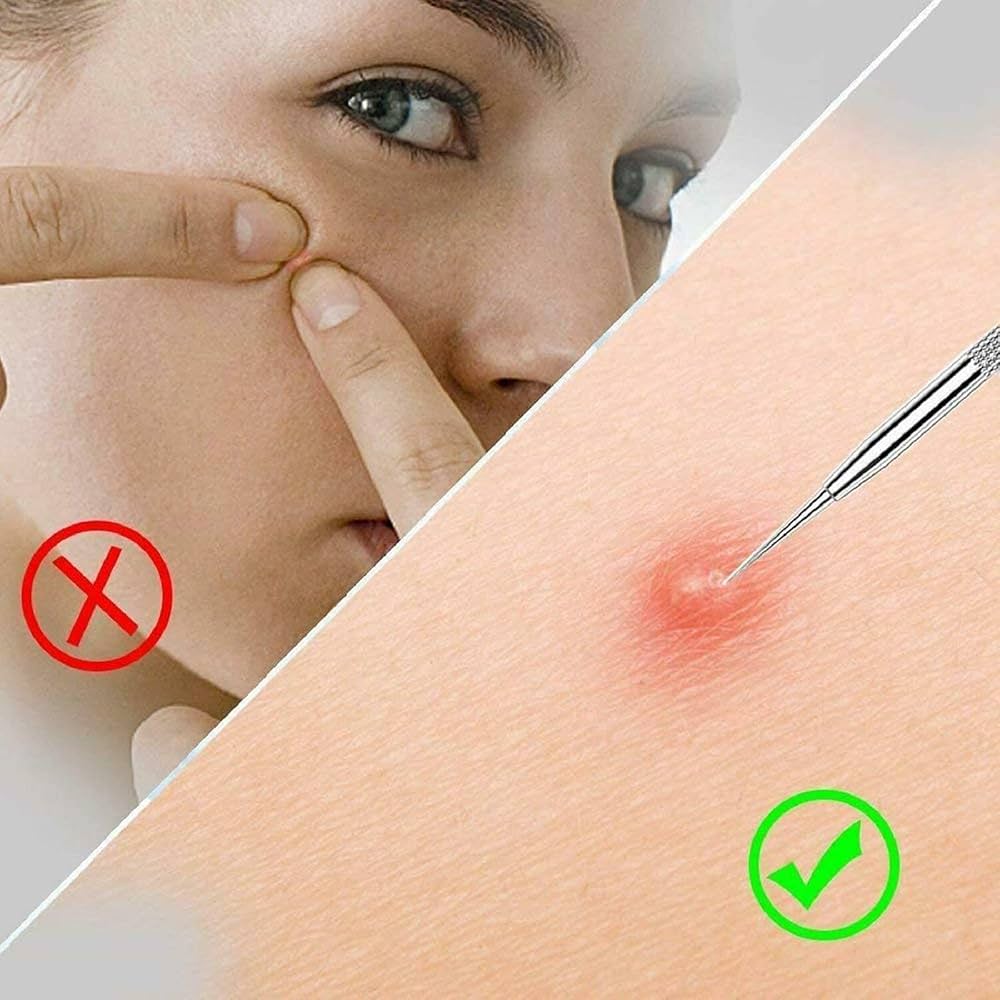 Problems Solved 4-piece blackhead removal tool kit with storage box, featuring silver extraction tools for nose and facial care.