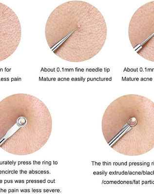 Problems Solved blackhead removal tool kit with four silver facial care tools and storage box for nose pore extraction.