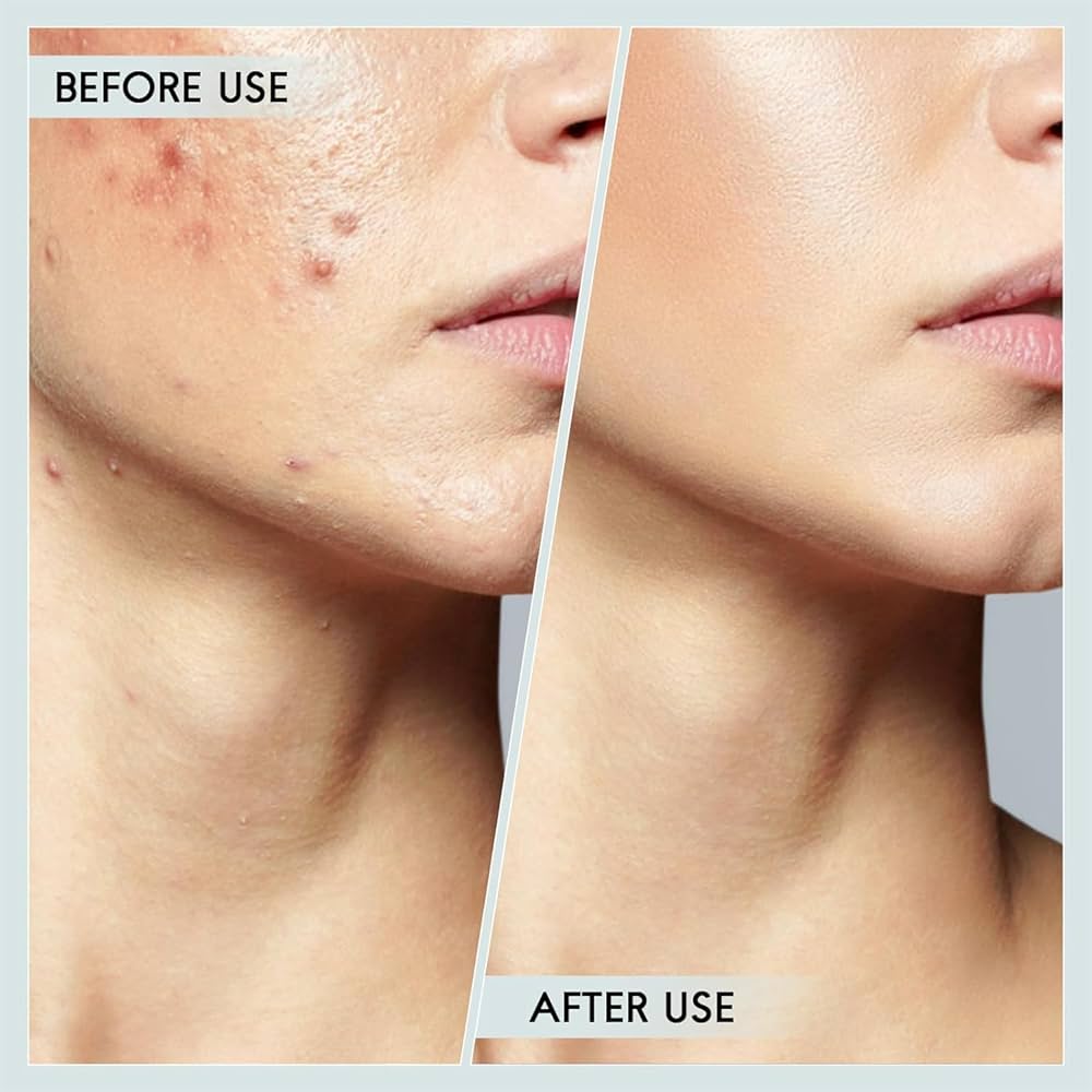 Problems Solved blackhead removal tool kit with four silver facial care tools and storage box for nose pore extraction.